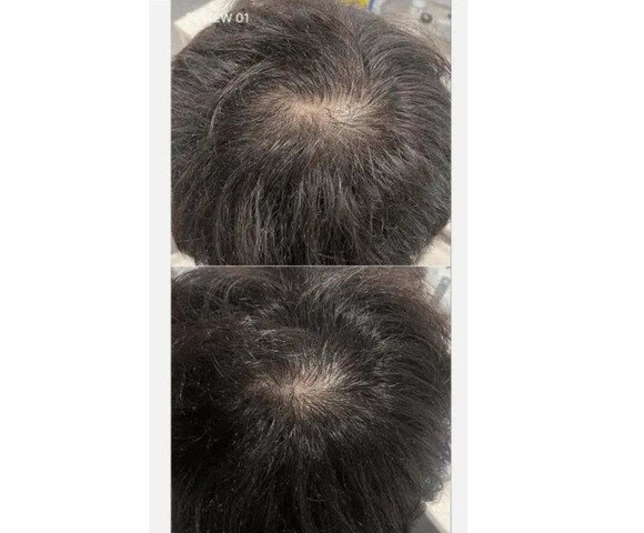 Medicube SOYXIDIL Σαμπουάν κατά της Τριχόπτωσης 490ml